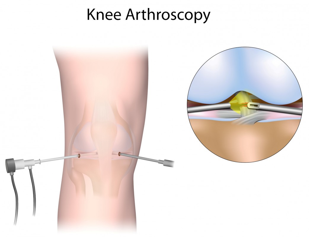 Zdjęcie - Artroskopia kolana
