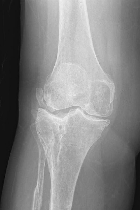 Endoproteza kolana 1 - zdjęcie przed