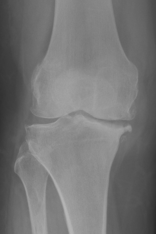 Endoproteza kolana 4 - zdjęcie przed