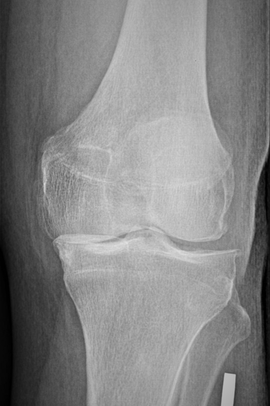 Endoproteza kolana 5 - zdjęcie przed