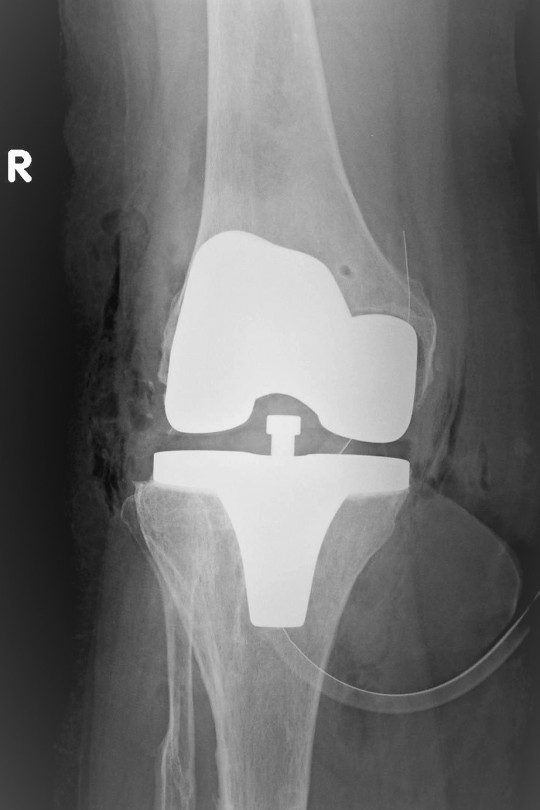 Endoproteza kolana 1 - zdjęcie po