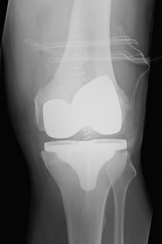 Endoproteza kolana 6 - zdjęcie po