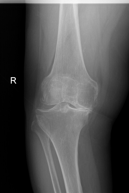 Endoproteza kolana 7 - zdjęcie przed