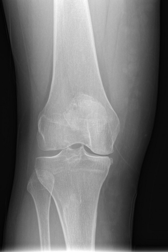 Osteotomia kolana 4 - zdjęcie przed