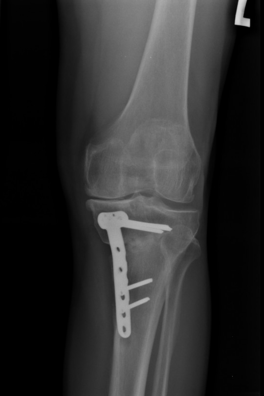 Osteotomia kolana 1 - zdjęcie po