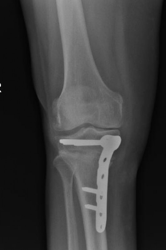 Osteotomia kolana 2 - zdjęcie po